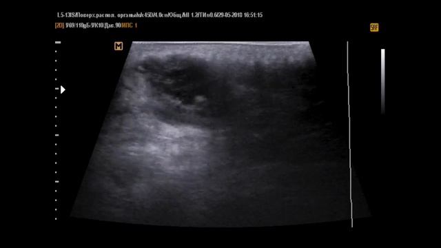 Образования мягких тканей, разные случаи на УЗИ. смотреть онлайн