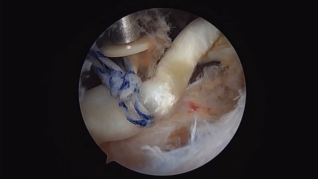 Slik Fix Biceps Tenodesis