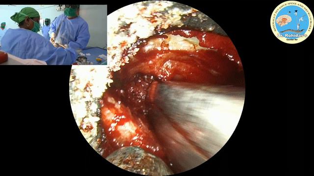 Lt. L 4/5 endoscopic disocectomy & canal decompression. смотреть онлайн