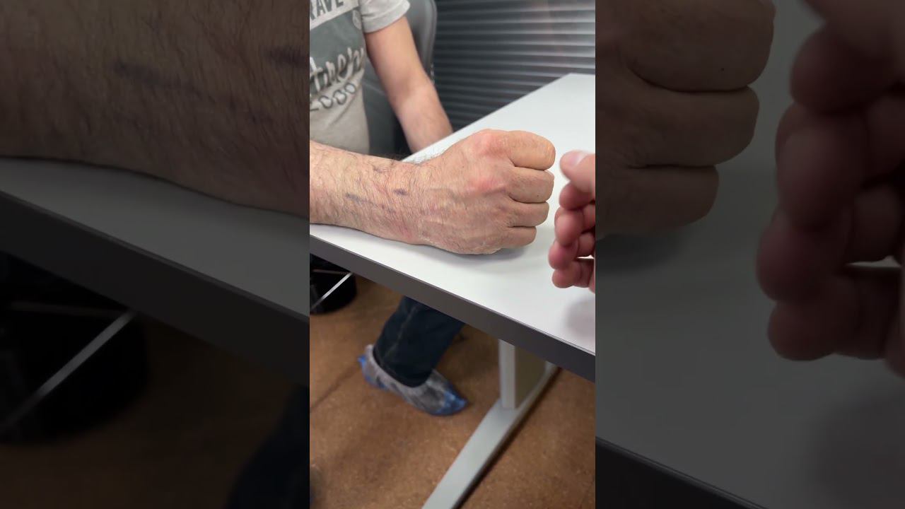 Функция Руки через 4 недели после перелома | Перелом Лучевой Кости смотреть онлайн