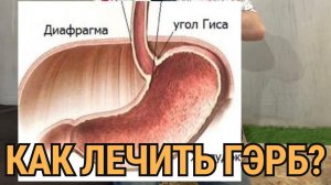 Как лечить ГЭРБ? Гастроэзофагеальная рефлюксная болезнь.