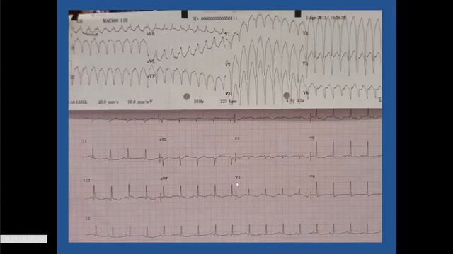 Approach to Wide QRS Tachycardia - Dr Jayakeerthi Y Rao смотреть онлайн