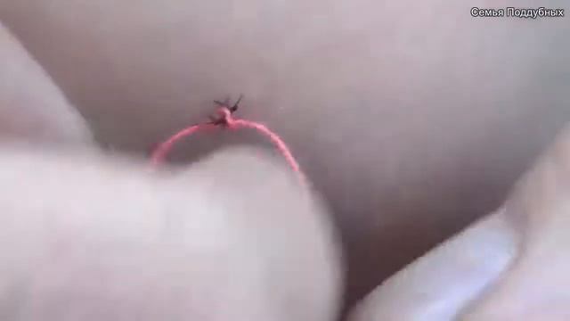 Как вытащить клеща из кожи смотреть онлайн