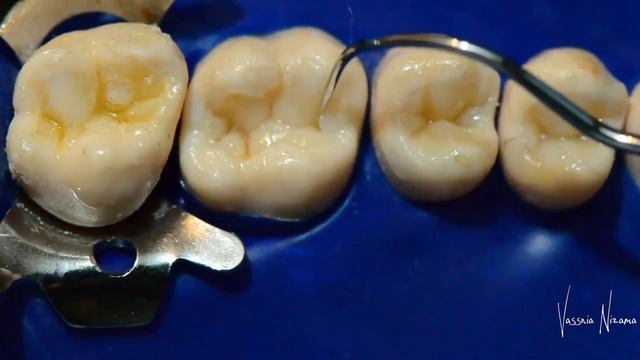 Реставрация жевательной поверхности зубов смотреть онлайн