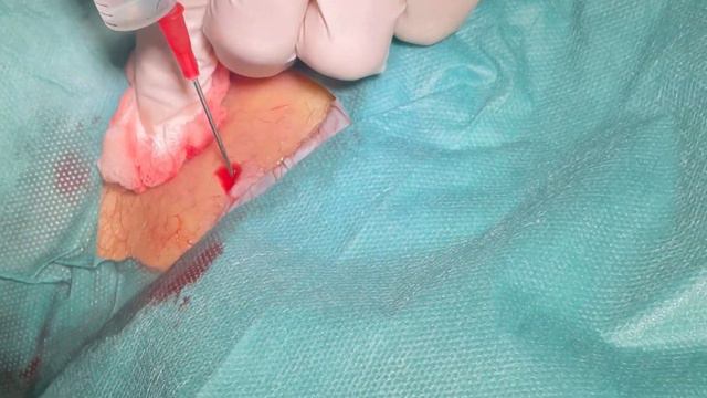 Abszeß in der Leiste behandeln. Dr. Kasten Hautmedizin in Mainz смотреть онлайн