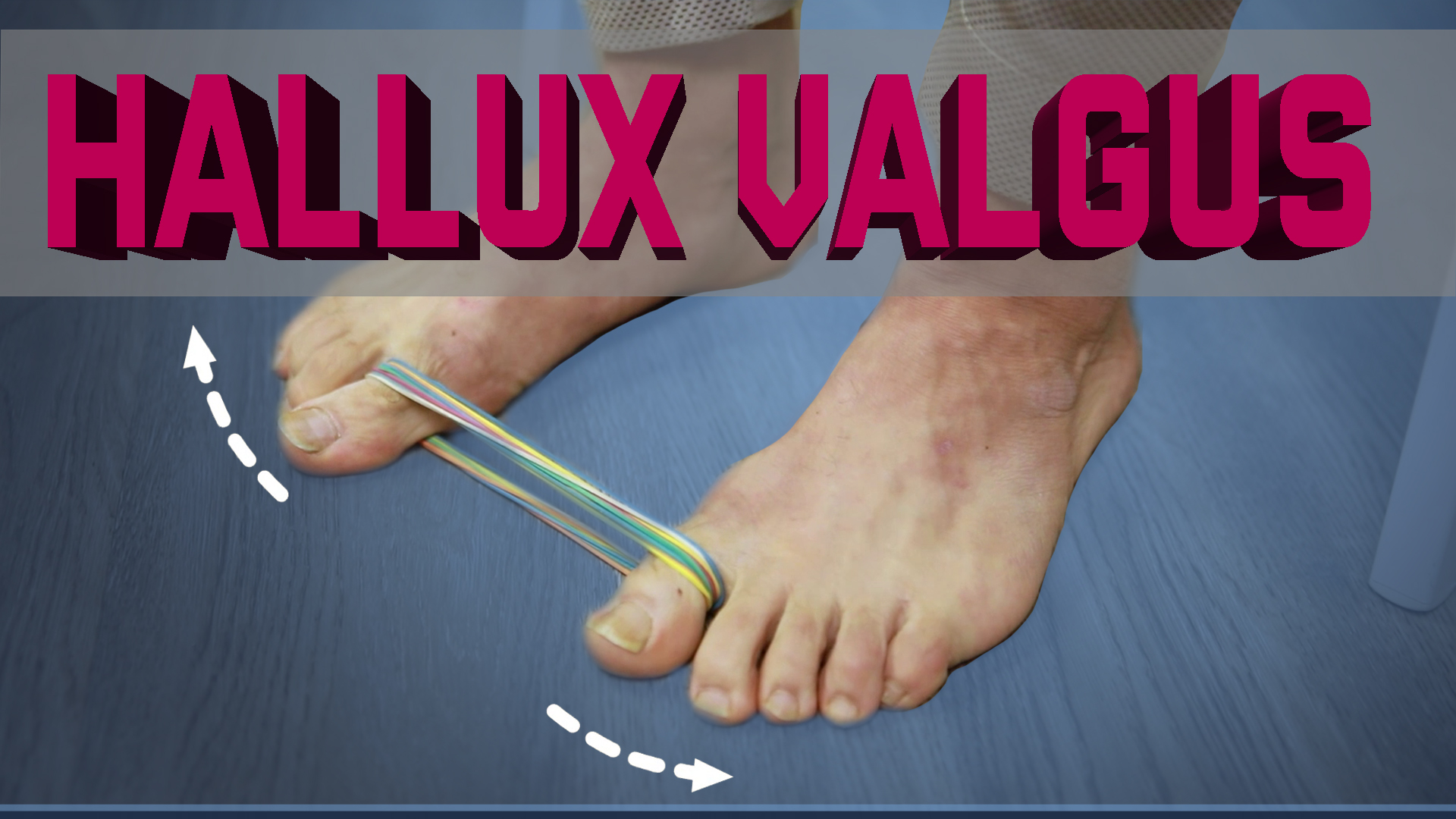 Hallux valgus. Как избавиться от косточки на большом пальце ноги без операций! смотреть онлайн