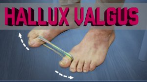 Hallux valgus. Как избавиться от косточки на большом пальце ноги без операций!