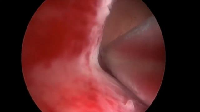 Heart Shaped Polyp Removed with the IBS смотреть онлайн