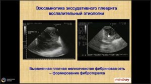 Методические основы УЗИ грудной клетки : УЗД плевральных выпотов и патологии плевры
