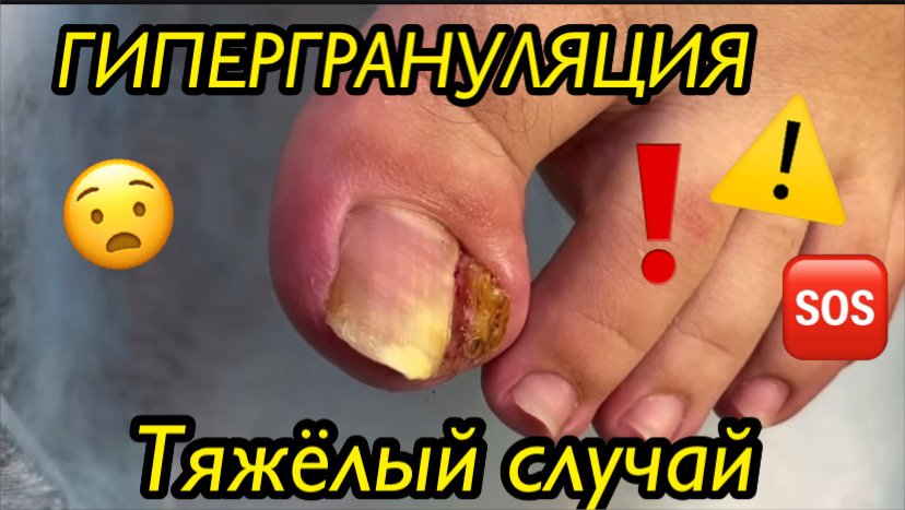ГИПЕРГРАНУЛЯЦИЯ ?⚠️❗️??? • Тяжёлый случай??? смотреть онлайн