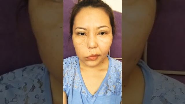 Парез лицевого нерва. Динамика восстановления.