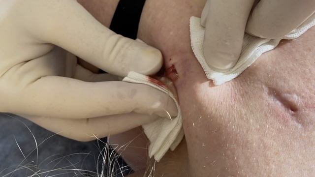 66.  Вскрытие гнойника - 4K