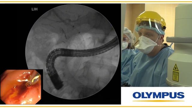 Клинический случай №2. Холедохолитиаз. Литоэкстракция. И. Ю. Недолужко смотреть онлайн