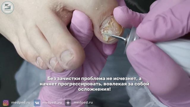 ОСТАВИЛИ БЕЗ НОГТЯ | Зачем подолог делает зачистку? | Убираем онихолизис | MEDPED смотреть онлайн