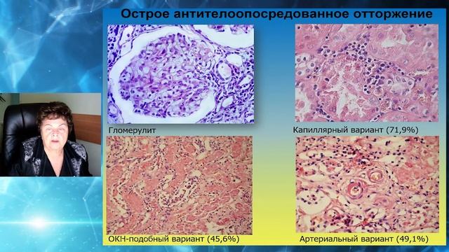 Морфологическая дисфункция почечного трансплантата. Никоненко Т.Н. смотреть онлайн
