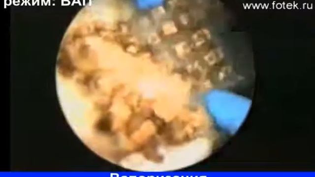 Вапоризация патологических образований в полости мочевого пузыря смотреть онлайн