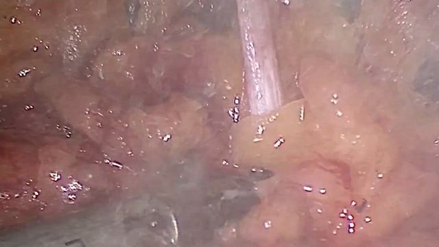 RIGHT SIDE PELVIC LYMPH NODE DISSECTION WITH REPAIR OF PARTIAL OBTURATOR NERVE INJURY смотреть онлайн