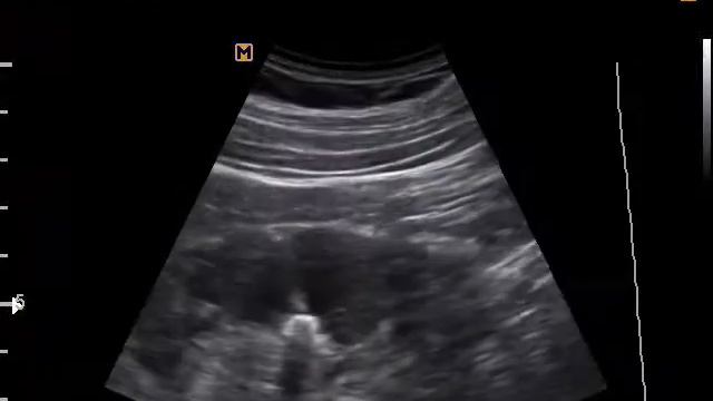 Конкременты почки( 24-7-17) смотреть онлайн