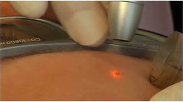 Фракционный СО2-лазер MedArt FRx смотреть онлайн