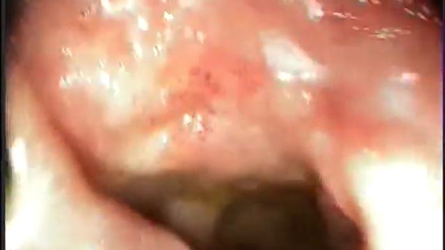 multiple bleeding ulcers множественные кровоточащие язвы смотреть онлайн