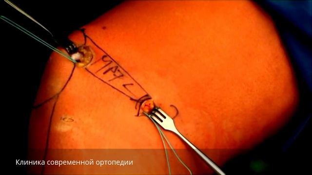 Пластика медиальной пателло-феморальной связки (МПФЛ) смотреть онлайн