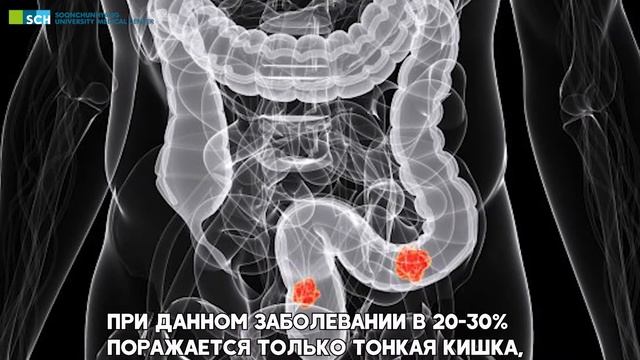 Болезнь Крона смотреть онлайн