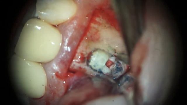 Апикальная микрохирургия зуба 1.1 смотреть онлайн