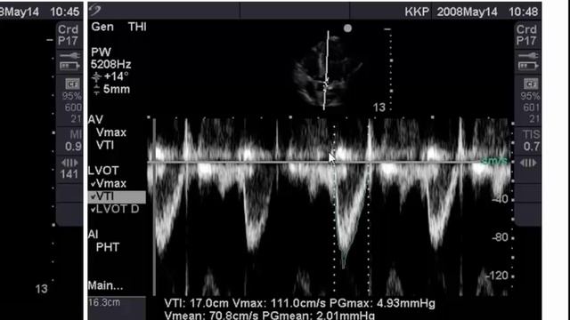 Point of Care Echo: Stroke Volume Determination смотреть онлайн