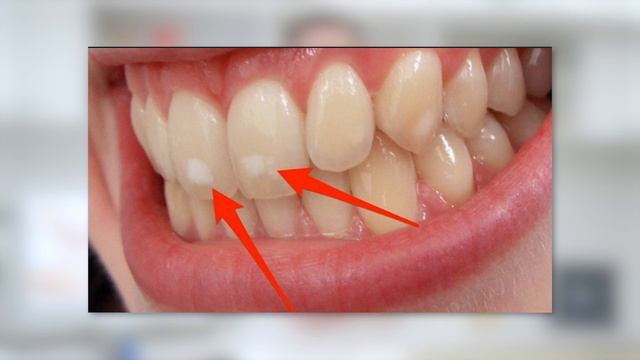 Что такое профессиональная чистка зубов смотреть онлайн