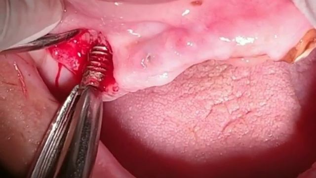 Implant Retrieval смотреть онлайн