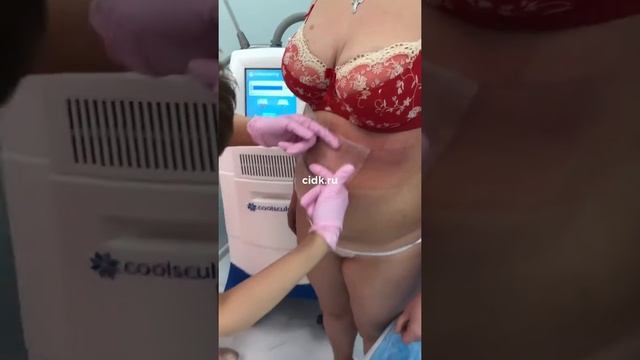 Как проходит процедура криолиполиза в ЦИДК? смотреть онлайн