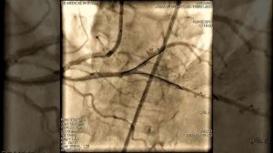 Стентирование сосудов сердца