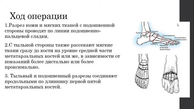 Ампутация стопы по Шарпу (трансметатарсальная ампутация) смотреть онлайн