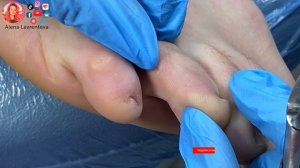Стержневая мозоль удаление / Межпальцевая мозоль на ноге