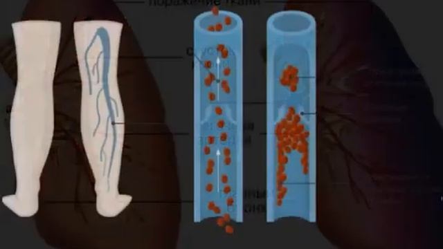 Легочная эмболия смотреть онлайн