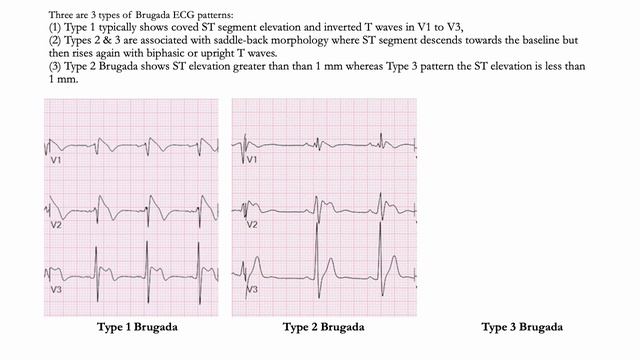 EKG Sunday | Is this benign? |Dr RR Baliga's "MUST KNOW EKG" Podkast for Physicians смотреть онлайн