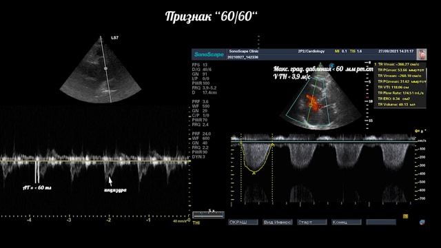 Тромбоэмболия легочной артерии (ТЭЛА) на эхокардиографии смотреть онлайн