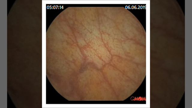 Капсульная эндоскопия в клинике Гиппократ. Точность превосходит наши самые смелые ожидания! смотреть онлайн