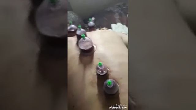 Хиджама, как я научилась ставить вакуумные банки смотреть онлайн