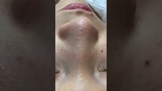 Чистка лица до и после#косметолог #kosmetologia #turkey #аёллар #чисткалица #юз #фойдали #тошкент смотреть онлайн