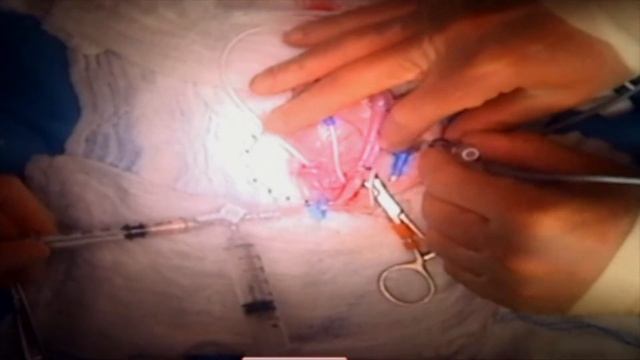 SUB 3.0 Surgical Training Video - 2020 WEISSE смотреть онлайн