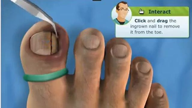 удаление ногтя Ingrown Toenail Surgery