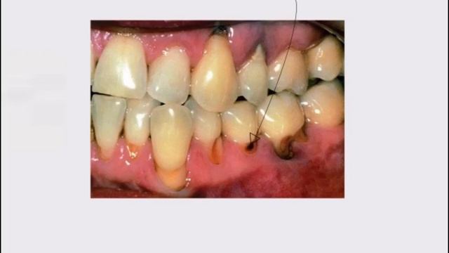 Microbiology Of Dental Caries смотреть онлайн