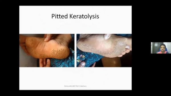 Ayurvedic Management of Skin diseases (Webinar)