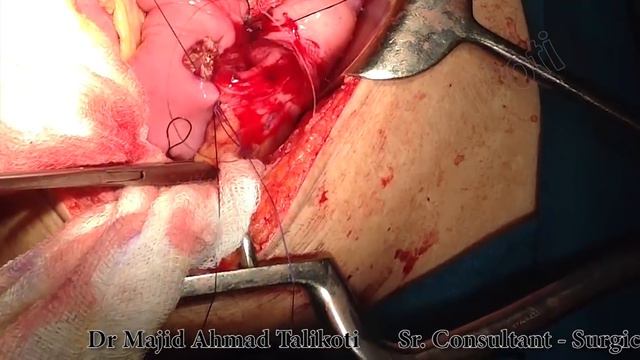 Subtotal Gastrectomy by Dr Majid Ahmed Talikoti | Cancer Surgery смотреть онлайн
