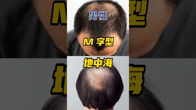 看看你的是不是何尔蒙脱发问题 смотреть онлайн