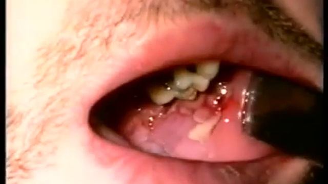 Дифтерия у взрослых, 1994 смотреть онлайн