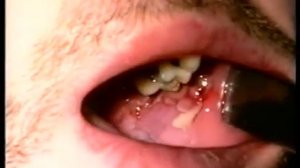 Дифтерия у взрослых, 1994