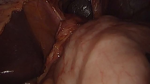 LINX & Hiatal Hernia Repair to Treat Reflux - Animation and Surgical Footage смотреть онлайн