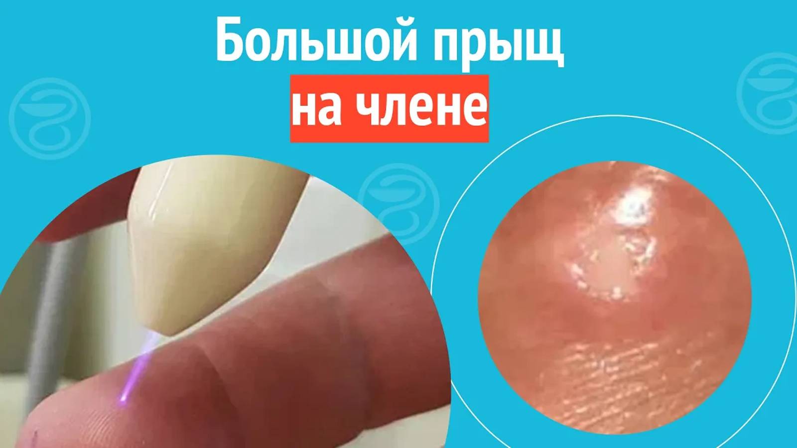 😮 Большой прыщ на члене. Клинический случай №1249 смотреть онлайн